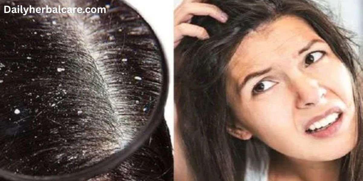 डैंड्रफ का देसी इलाज