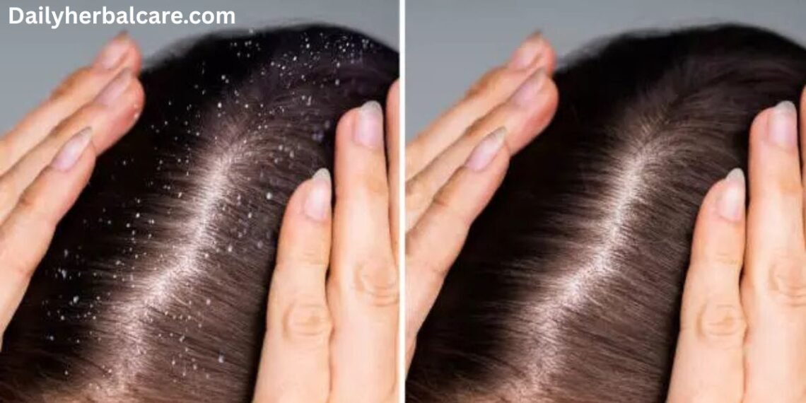डैंड्रफ का देसी इलाज