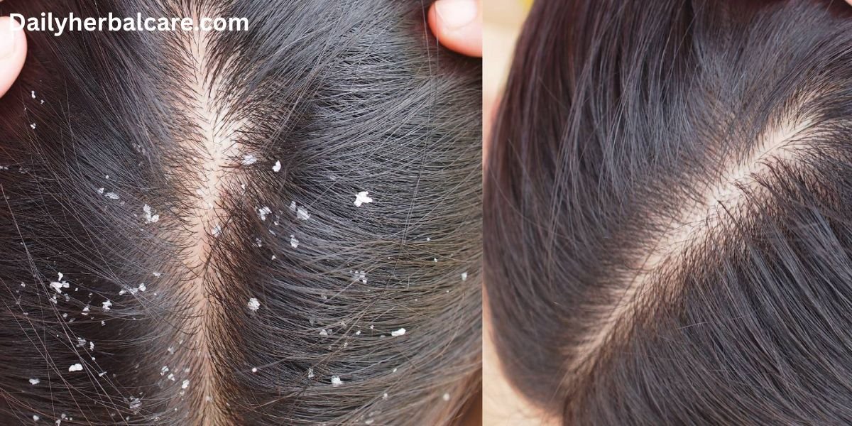 डैंड्रफ का देसी इलाज