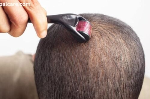 Microneedling for Hair Loss at Home